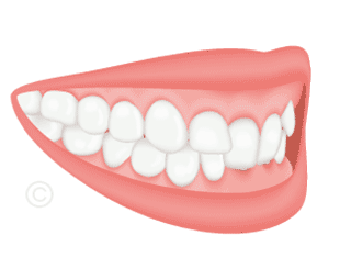 Orthodontiste Boulogne-Billancourt – diagnostic Supraclusion 