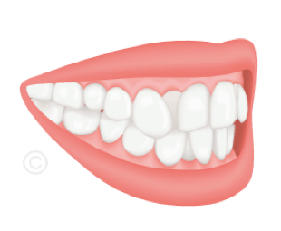 Orthodontiste Boulogne-Billancourt - Traitement encombrement dentaire 
