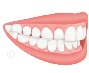 Orthodontiste Boulogne-Billancourt - Occlusion croisée