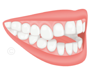 Dentiste Boulogne-Billancourt - Infraclusion